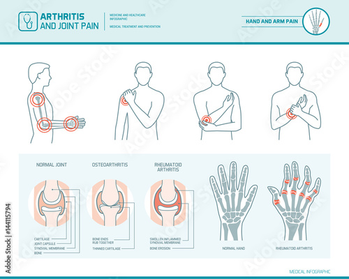 Arthritis and joint pain
