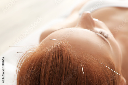 Therapy of female head with pricking acupuncture needles