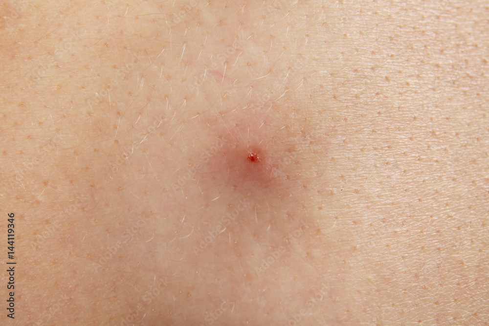 Human skin with pimple, closeup