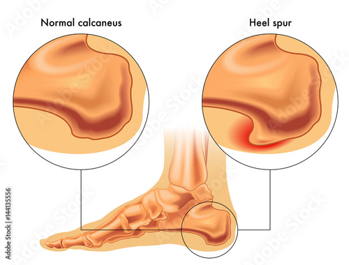 heel spur