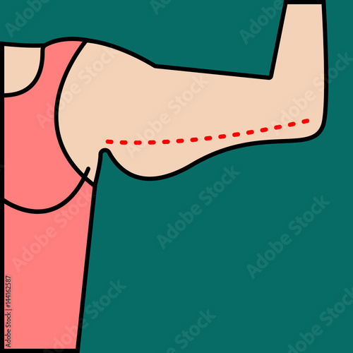 Liposuction of arms