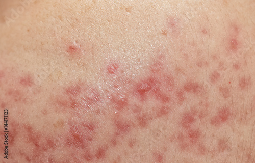 closeup skin problems, nodular cystic acne skin