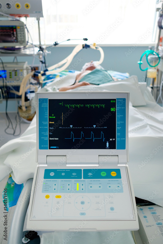 intensive care patient on ventillator and IABC support intensive care patient on ventillator and IABC support