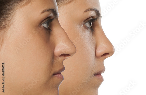 comparative portrait of a young woman before and after nose correction photo