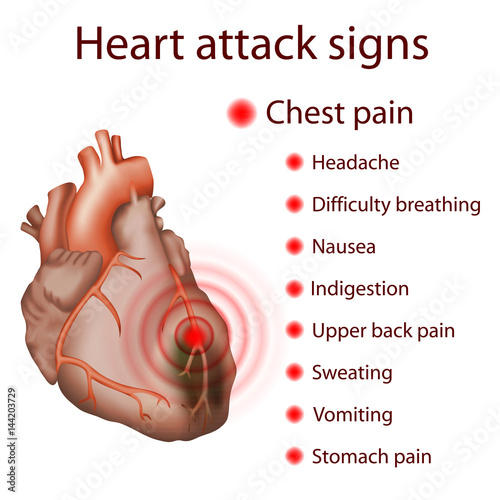 Heart attack signs. Myocardial infarction. Damaged heart muscle. Medical, anatomical illustration.
