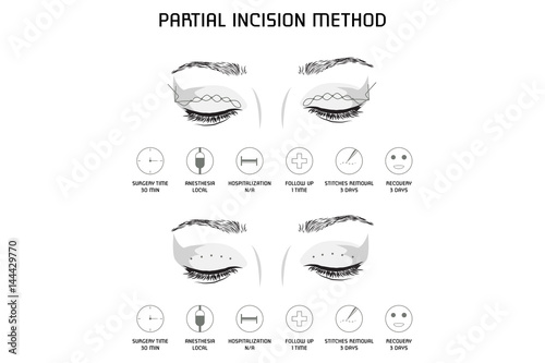 Full Incision Method. Vector Illustration. Medical Poster.