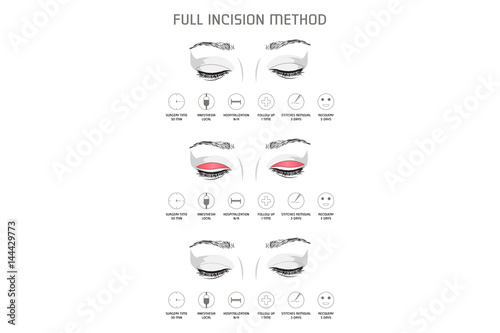 Full Incision Method. Vector Illustration. Medical Poster.
