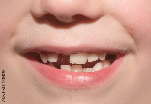 Child mouth of toddler without anterior milky tooth. Toothless smile. Child lost front tooth. Tooth Fairy. Children's dediatric dentistry, dental care, go to the dentist. Frank carefree serene smile