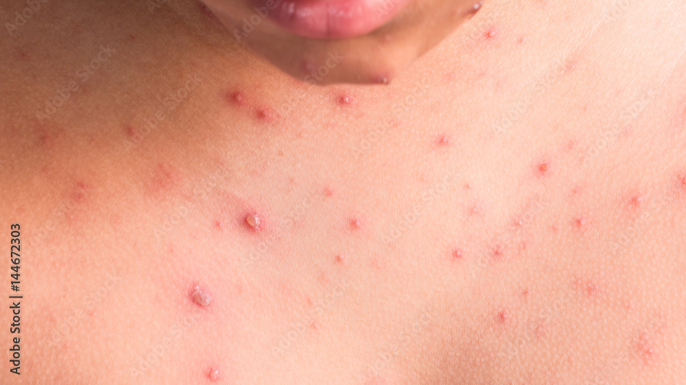 Chicken pox rash Chicken pox rash