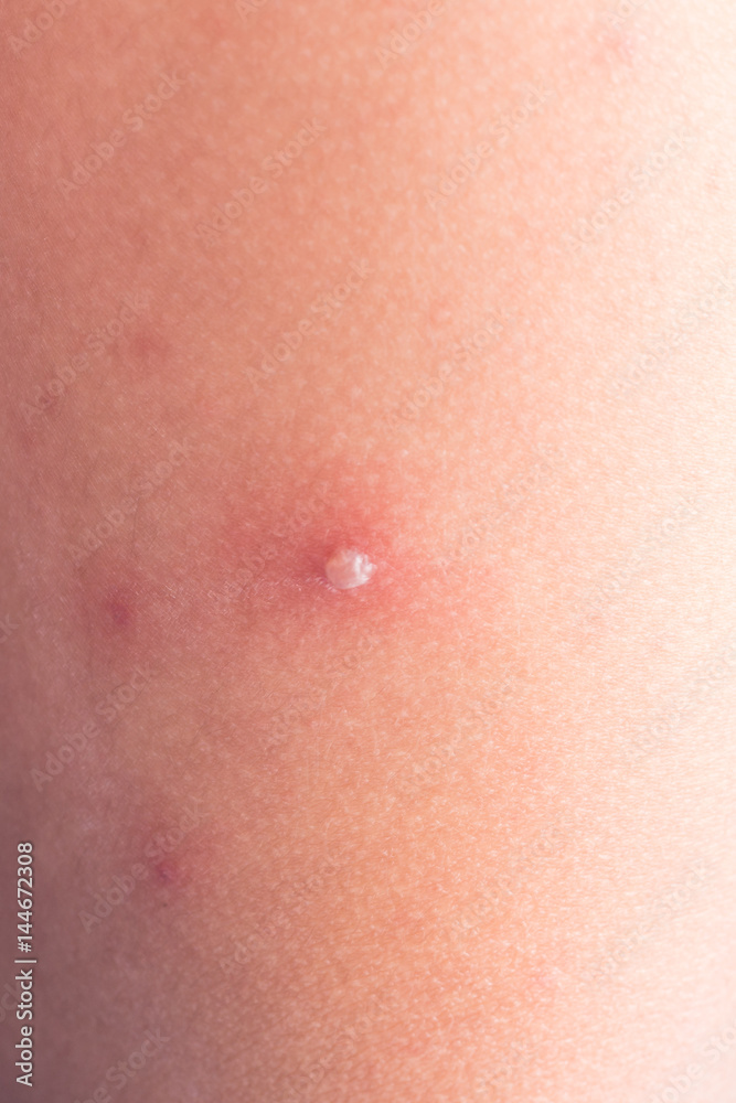 Chicken pox rash Chicken pox rash