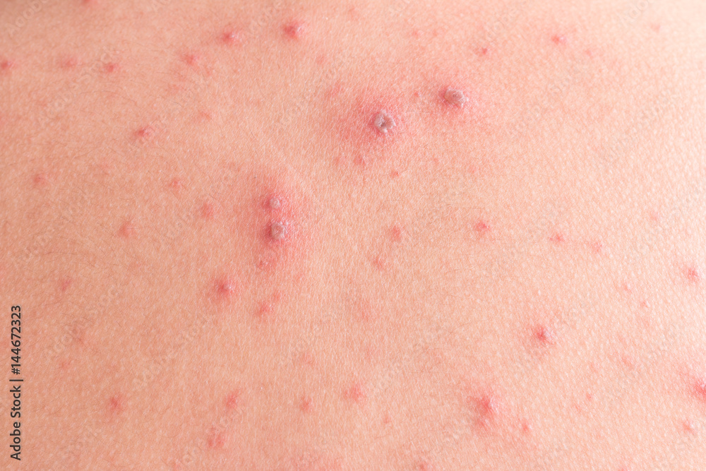 Chicken pox rash Chicken pox rash