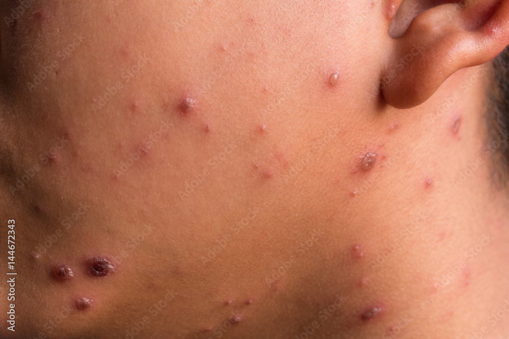 Chicken pox rash Chicken pox rash