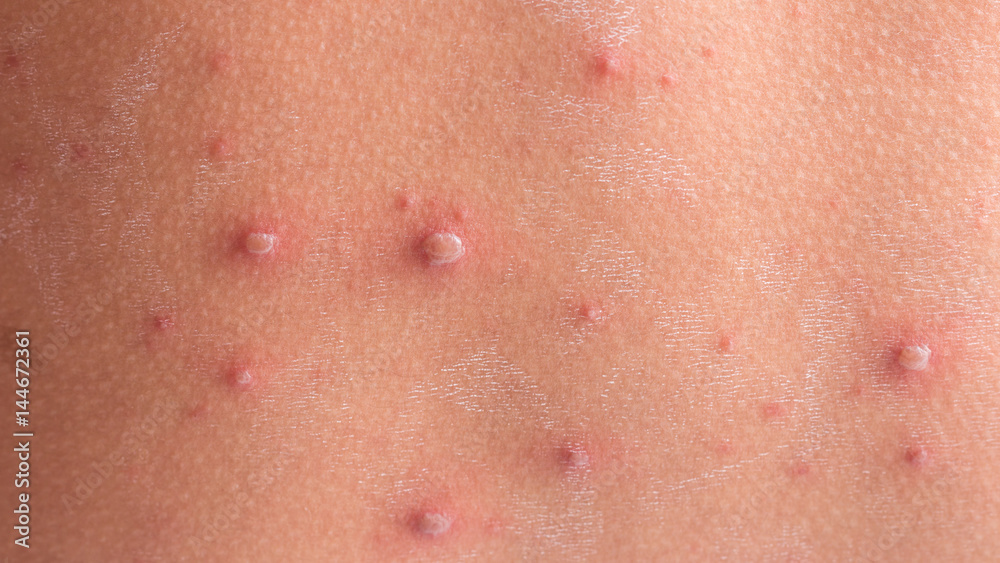 Chicken pox rash