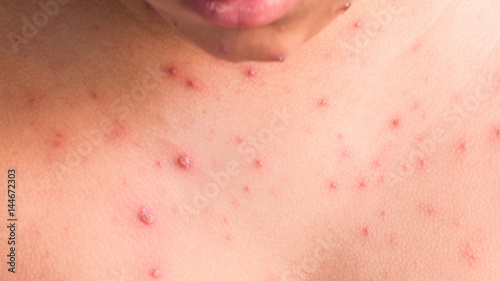 Chicken pox rash photo