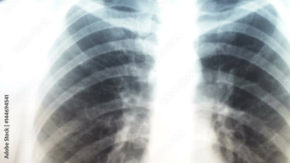 X-ray of human lungs.Diagnostics for prevention of lung cancer. X-ray of human lungs.Diagnostics for prevention of lung cancer.