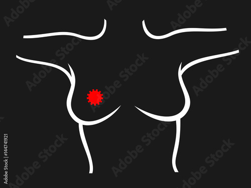 Breast cancer diagnosis - scanning of chest of woman. Detection of lump - tumor, carcinoma. Simple vector illustration