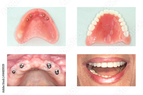 dental implant of upper jaw