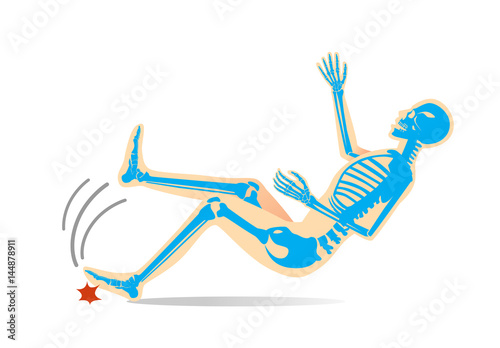 Physical injury from slip accident. Illustration about safety lifestyle.