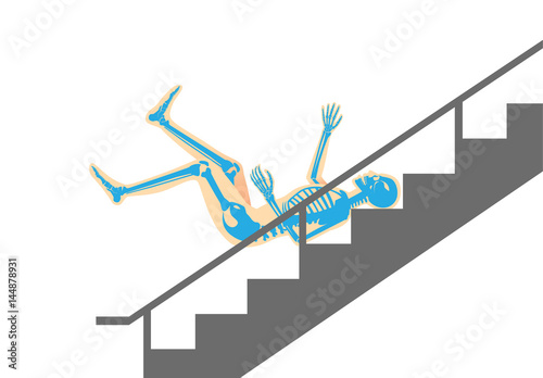 Human have physical injury from falling down stairs. Illustration about bone pain.