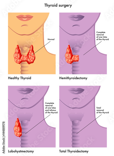 thyroid surgery photo