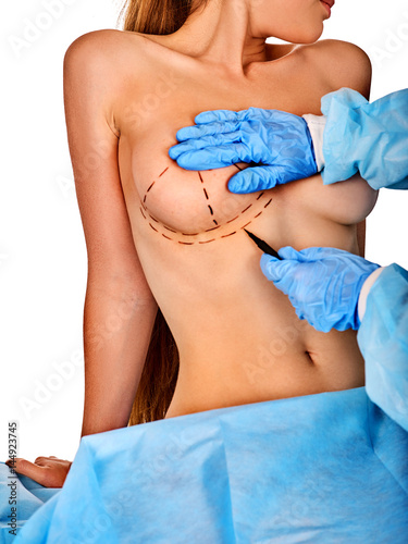 Plastic surgery doctor drawing line on woman patient breast augmentation implant. Doctor makes dotted lines on female body for cellulite correction. Lifting breast and plastic surgery .