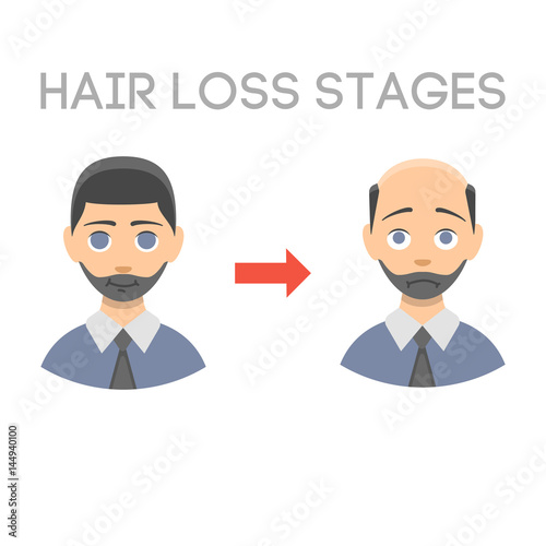 Information chart of hair loss stages types of baldness illustrated on male head vector.