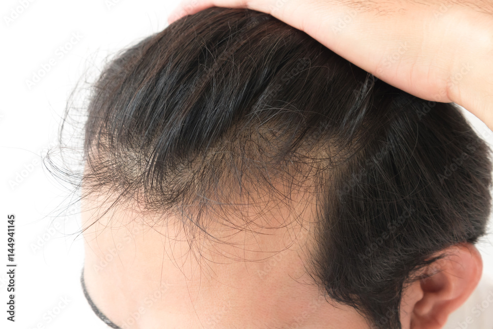 Fototapeta premium Young man serious hair loss problem for health care shampoo and beauty product concept