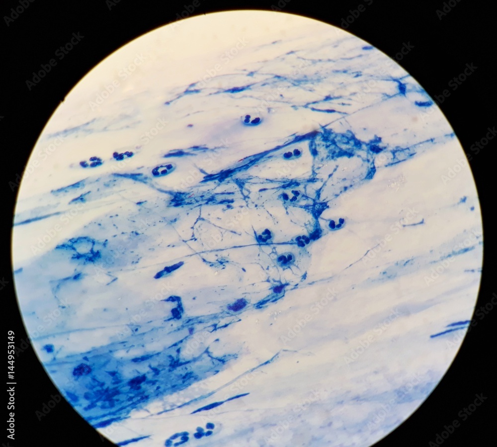 Smear of Acid-Fast bacilli (AFB) stained from sputum specimen, under 100X light microscope.