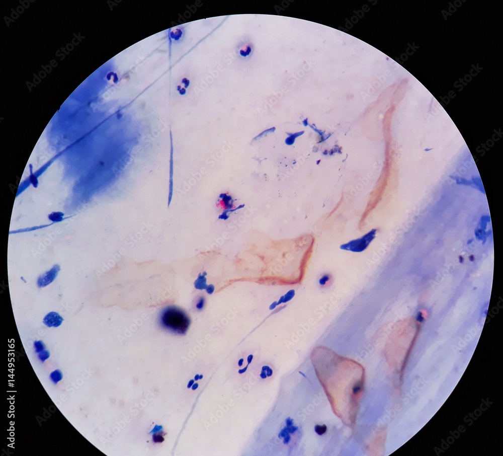 Smear of Acid-Fast bacilli (AFB) stained from sputum specimen with positive  Mycobacterium tuberculosis (MTB), under 100X light microscope. Stock Photo  | Adobe Stock