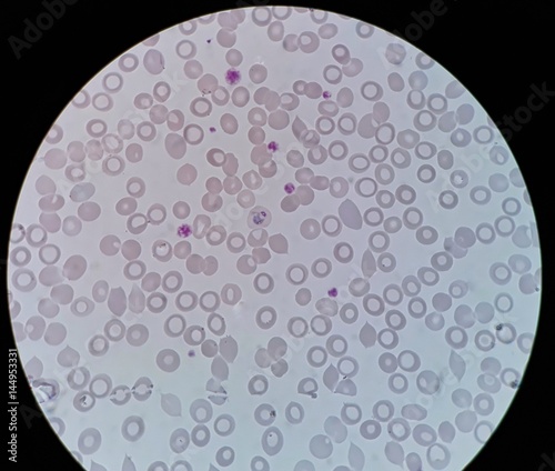 Human parasite under 100X light microscope; thin film of blood smear with trophozoite form malaria infected red blood cell, belong to Plasmodium vivax infection. photo