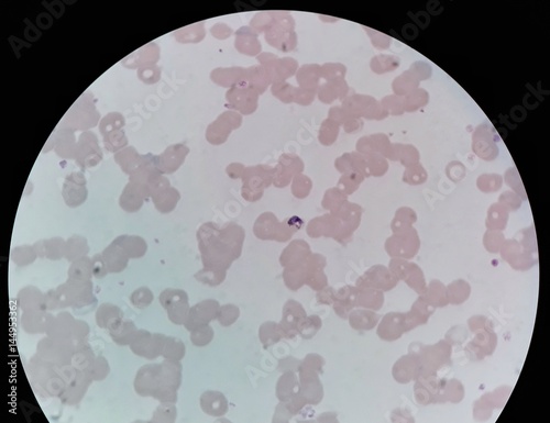 Human parasite under 100X light microscope; thin film of blood smear with trophozoite form malaria infected red blood cell, belong to Plasmodium malariae infection. photo