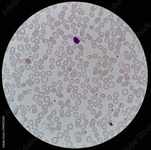 Human parasite under 100X light microscope; thin film of blood smear with trophozoite form malaria infected red blood cell, belong to Plasmodium vivax infection. photo