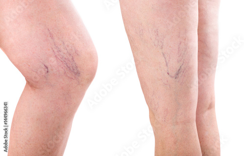 leg. legs with varicose spider veins