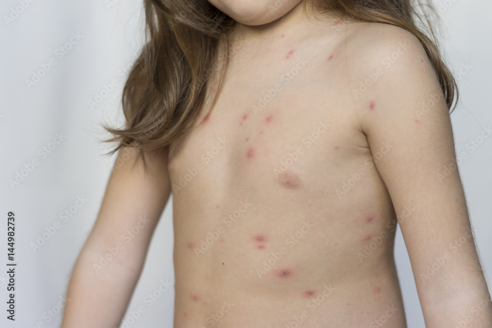 Varicella virus or Chickenpox bubble rash on child, baby or adoult Varicella virus or Chickenpox bubble rash on child, baby or adoult