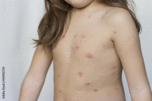 Varicella virus or Chickenpox bubble rash on child, baby or adoult
