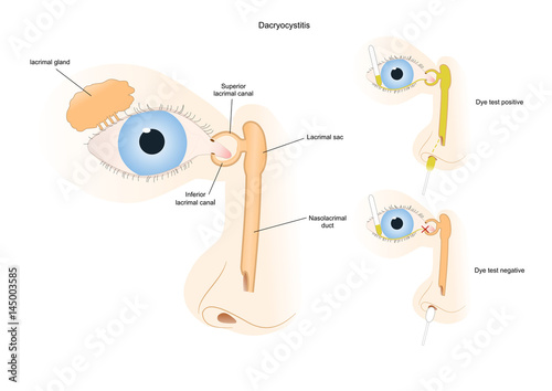 dacryocystitis, an infection of the lacrimal sac (eye), with a test to check if there is an obstruction photo