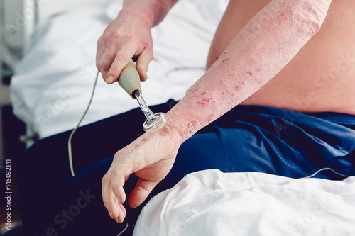 patient with a skin disease keeps the Darsonval electric shock device for treating dermatitis, apathy, seborrhea, eczema. photo