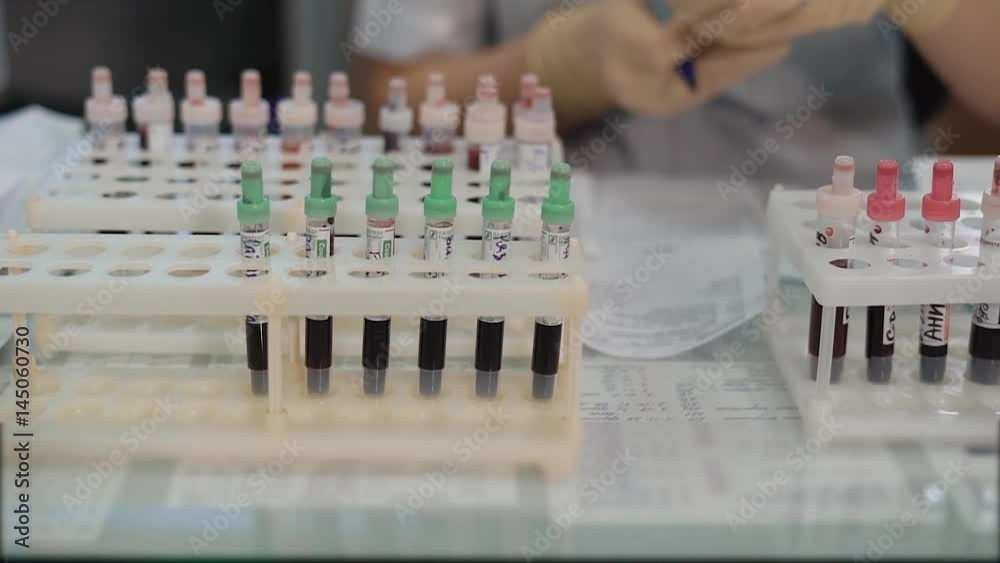 Close up of set of test tubes with blood samples for medical examination in medical laboratory. Rack of glass containers filled with specimens for research with hands of nurse in the background. Close up of set of test tubes with blood samples for medical examination in medical laboratory. Rack of glass containers filled with specimens for research with hands of nurse in the background.