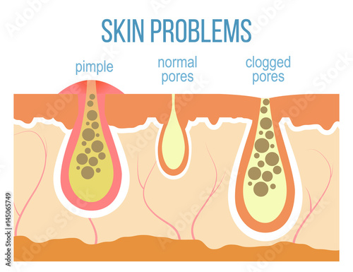 Skin problems - acne, pimples and clogged pores. Skin pores close up. Vector.