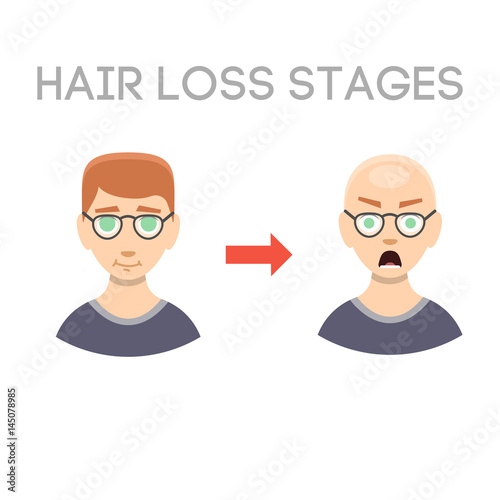 Information chart of hair loss stages types of baldness illustrated on male head vector.