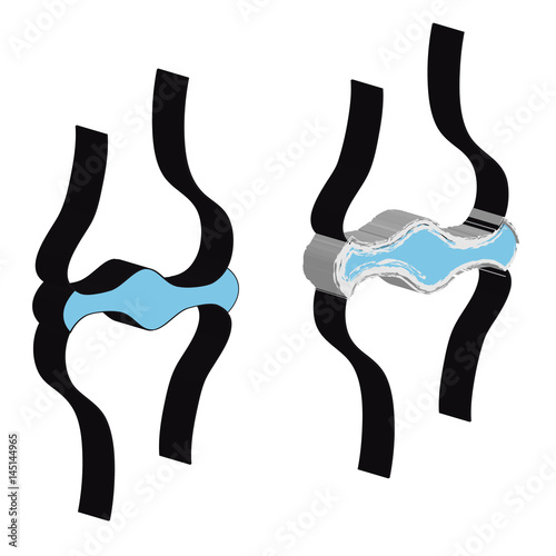 3D Joint with cartilage and arthritis