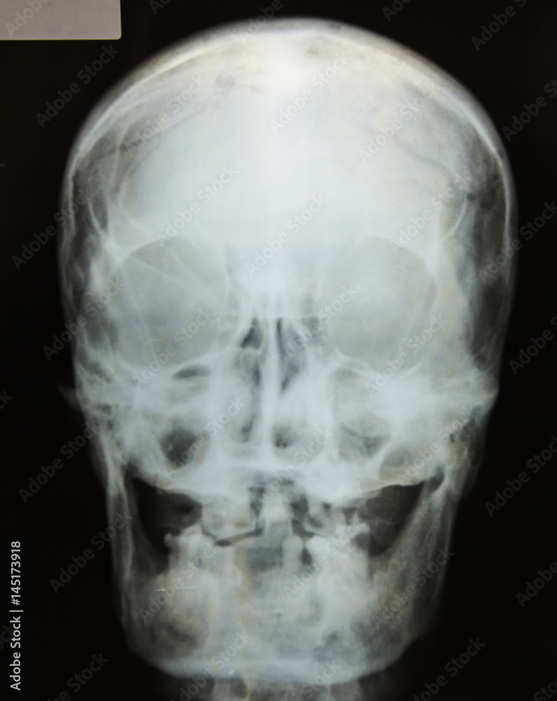 X-ray picture of the skull X-ray picture of the skull