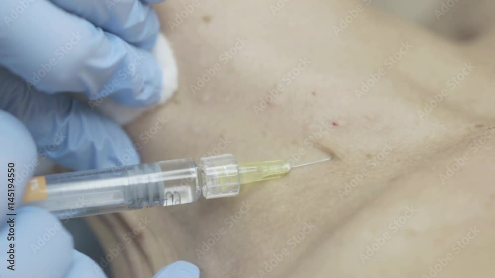 Close-up of a botox injection in the neck in the beauty salon Close-up of a botox injection in the neck in the beauty salon