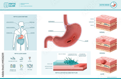 Peptic ulcer and helicobacter pylori infographic photo