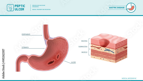Peptic ulcer medical illustration
