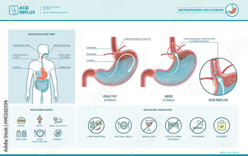 Acid reflux and heartburn infographic