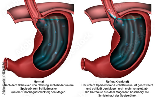 Refluxösophagitis, Refluxkrankheit mit Beschreibung auf deutsch, vektor illustration