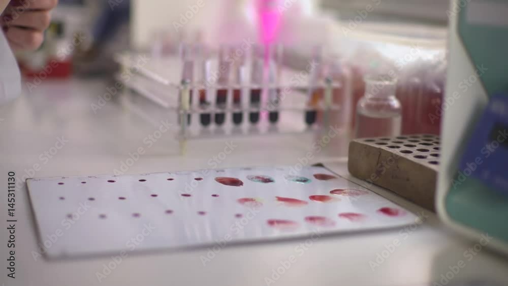 Hands close up of laboratory technician while using pipette to determinates blood types on the white plate, shallow depth of field, dolly shot Hands close up of laboratory technician while using pipette to determinates blood types on the white plate, shallow depth of field, dolly shot