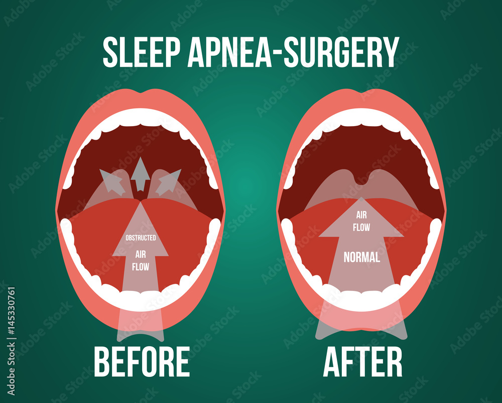 Vector illustration of surgery for obstructive sleep apnea, before and after result. Stock