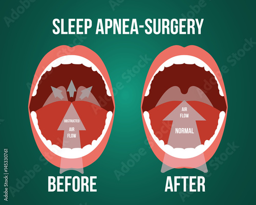 Vector illustration of surgery for obstructive sleep apnea, before and after result.